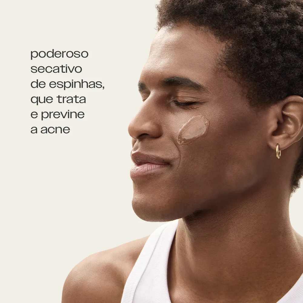 Sérum Antiacne aplicado no rosto, poderoso secativo de espinhas